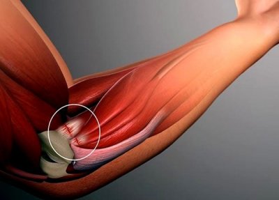 Cubital Tunnel Syndrome: Symptoms, Causes, and Treatment Options